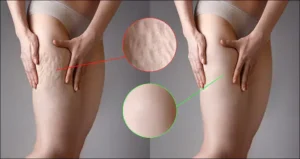 Decoding Cellulite: Causes, Treatments, and Myths Unveiled