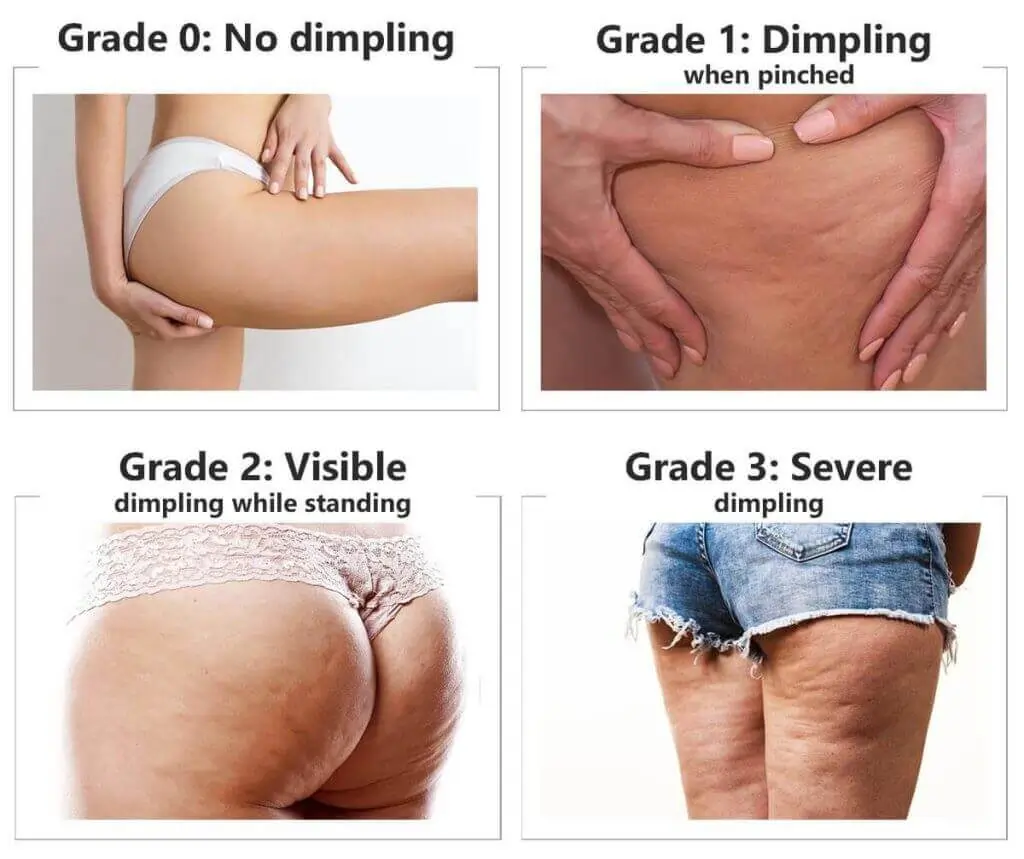 Representation of the stages of cellulite development 